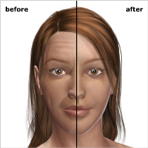 collagen filler result